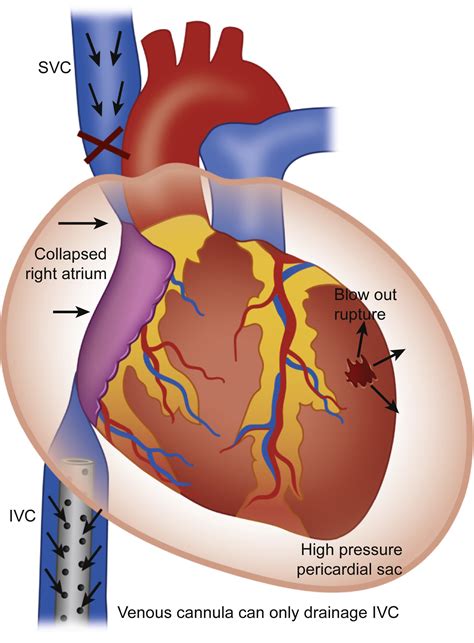 lv free wall|cardiac free wall rupture.